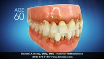 Invisalign Dentist Hanover NH