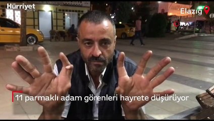 Elazığ’da 11 parmaklı adam görenleri hayrete düşürüyor