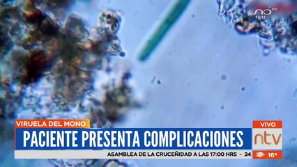 Paciente con viruela del mono se encuentra en riesgo