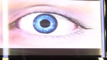 Retina artificiale su un paziente con maculopatia, primo in Italia