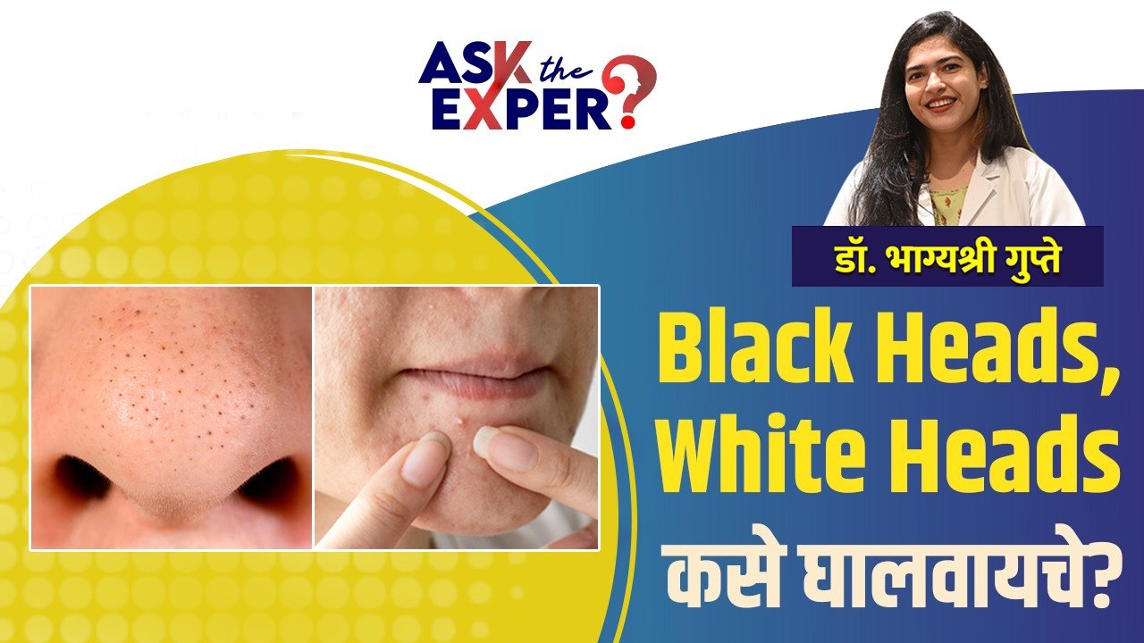Black Heads - White Heads कसे दूर करावेत? | How To Remove Blackheads & Whiteheads | Ask the Expert