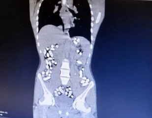 İran'dan gelen 5 kişinin midesinde 6 kilo 145 gram afyon sakızı ele geçirildi