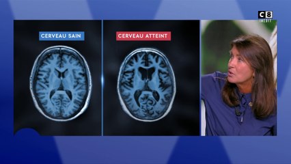 Votre santé : L'alzheimer,ce que vous ne saviez pas !