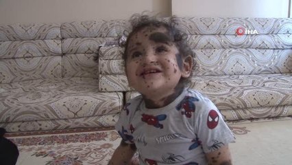 Vücudunda kitleler bulunan 14 aylık Abdurrahman yardım bekliyor