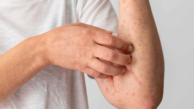 “Lo que viví no se lo deseo a nadie”: joven que resultó contagiado con viruela del mono