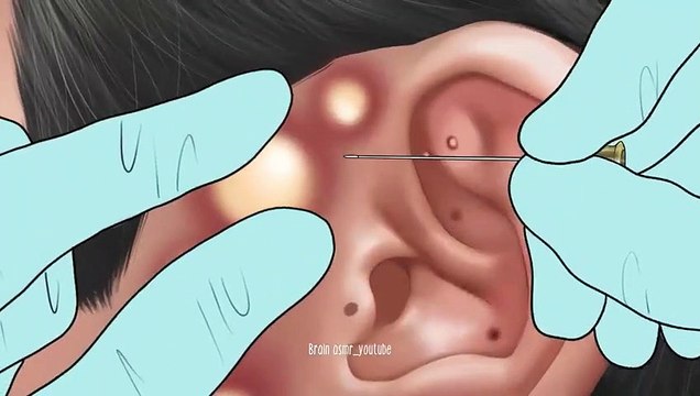 AAMR Pimple blackhead and sebaceous cyst removal for gamer _ Massage ear - Tingle animation(480P)