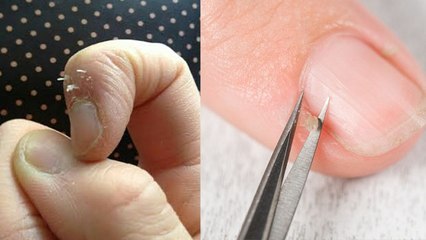 नाखूनों के पास की खाल उखड़ने का कारण | Nakhun ke pass ki skin fatna kesa hai | Boldsky *health