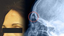 सिर पर उभरी हुई हड्डी या गांठ क्या होती है । ऑस्टियोमा होने का कारण | Osteoma | Boldsky *Health