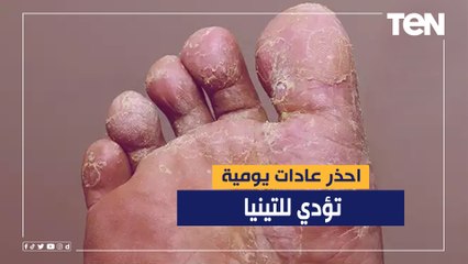احذر عادات يومية تؤدي لـ"تينيا القدم"
