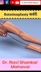 Rotationplasty Surgery #shorts #3d  @Dr. Ravi Shankar Mahavar ​