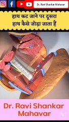 Hand Transplant #shorts #3d  @Dr. Ravi Shankar Mahavar ​