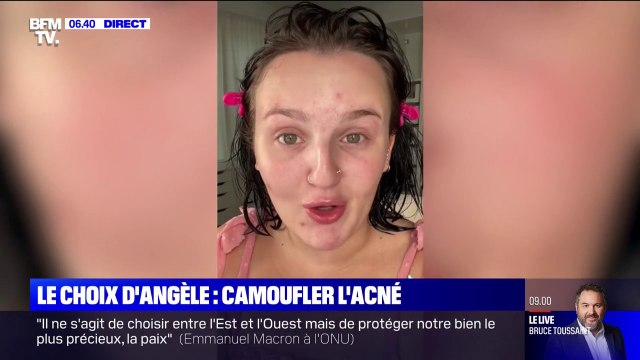 Le choix d'Angèle - Qu'est-ce que la Sticky Method , l'astuce pour camoufler ses boutons d'acné devenue virale sur TikTok?