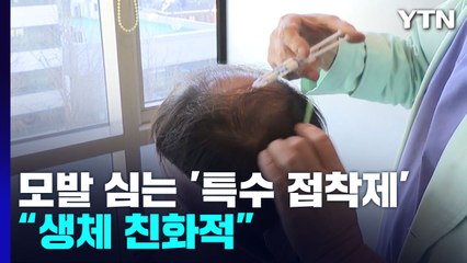 모발 심어주는 접착제 개발...탈모 해결 실마리 / YTN