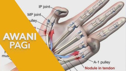 AWANI Pagi: Apakah Itu Trigger Finger?
