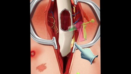 Nose surgery 3d animation