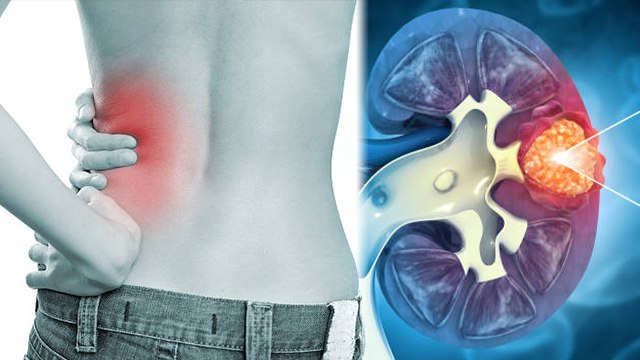 किडनी में दर्द क्यों होता है , किडनी में दर्द होने का कारण | Boldsky *Health