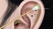 Satisfying Ear Cleaning Therapy  ASMR pimple, blackhead removal animat