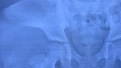 Küçük çocuğun cinsel organı için ultrason isteyen doktorlar, görülmemiş bir vaka ile karşılaştı