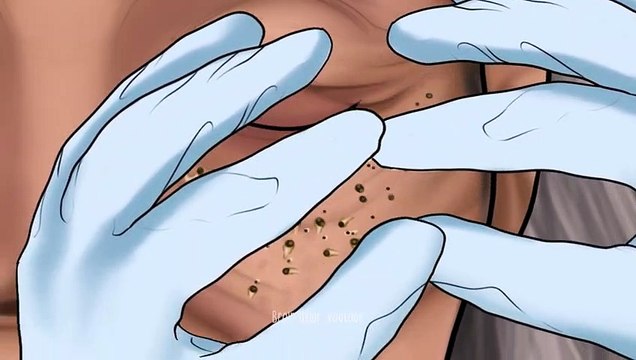 ASMR Blackhead removal for 70 years old homeless woman _ Skin care animation(480P)