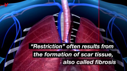 3 Ways COVID-19 Can Damage Lungs Long-term