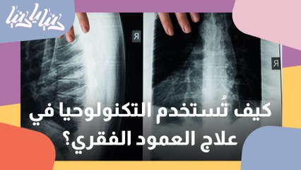 استعمال التكنولوجيا لعلاج أمراض العمود الفقري