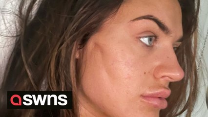 Woman whose botched thread lift left her looking like a 'halloween character' is warning others unsafe cosmetic clinics