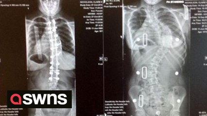 Woman completes third London Marathon - despite having pins in her back to straighten a curved spine