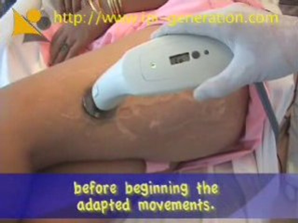 Anti Cellulitis radio frequency