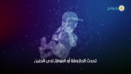 ما هي حازوقة الجنين وما هي أسبابها