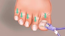 ✅ Title   ASMR Coolness! Ingrown Toenail removal treatment animation New Episode Part ( 1)