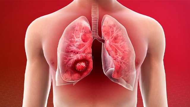 फेफड़ों का कैंसर कैसे होता है ? | कैंसर के लक्षण क्या होते हैं | Lung Cancer Symptoms | *health