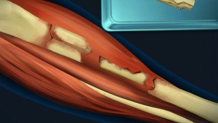 HOW LEG BONE SURGERIES ARE DONE