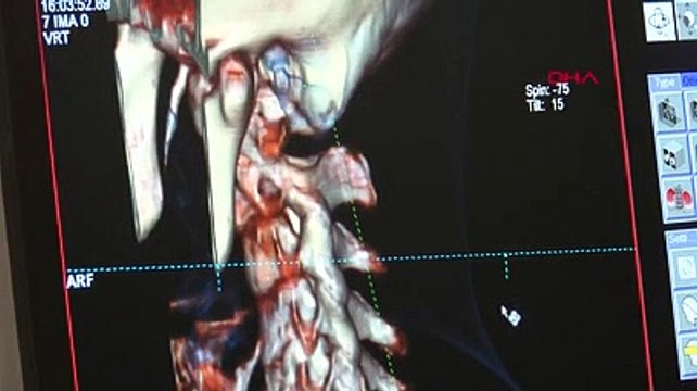 Aşırı cep telefonu kullanımı kireçlenme vakalarında artışa neden olacak