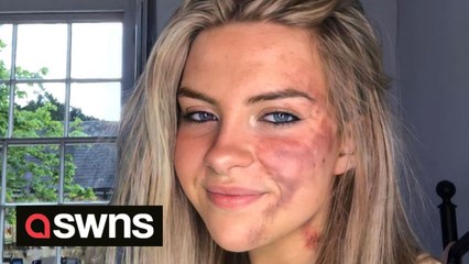 Скачать видео: Woman with a skin condition that causes bruise-like rashes all over her face is embracing her natural look