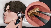 Ear wax cleaning | asmr animation