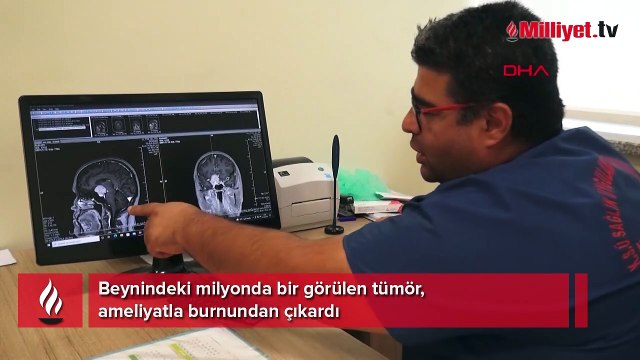 Beynindeki milyonda bir görülen tümör, ameliyatla burnundan çıkardı
