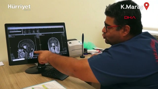 Beynindeki milyonda bir görülen tümör, ameliyatla alındı