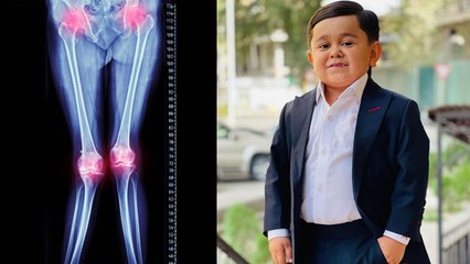 Abdu Rozik को हैं ये दो गंभीर बीमारियां, Brain Tumor भी इसका एक लक्षण | Boldsky *health