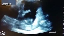Anne karnında alkış tuttu, ultrasona böyle yansıdı