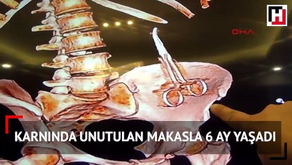 Ameliyatta karnında unutulan makasla 6 ay yaşadı