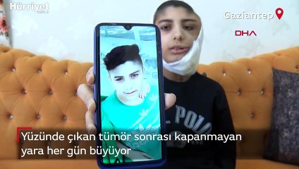 Yüzünde çıkan tümör sonrası kapanmayan yara her gün büyüyor