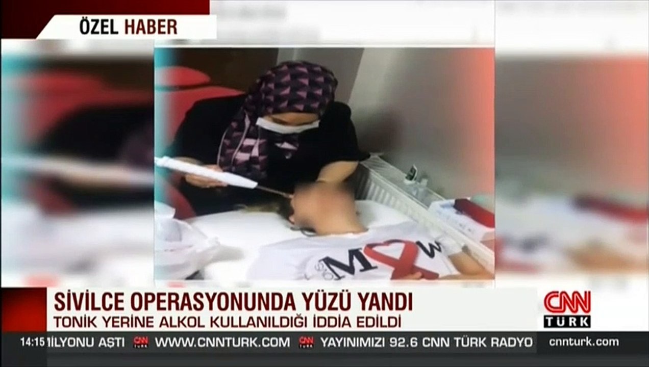 Sivilce operasyonunda yüzü yandı