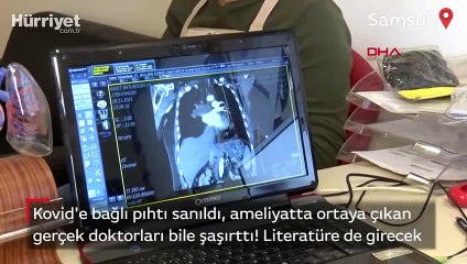 Kovid'e bağlı pıhtı sanıldı, ameliyatta ortaya çıkan gerçek doktorları bile şaşırttı!