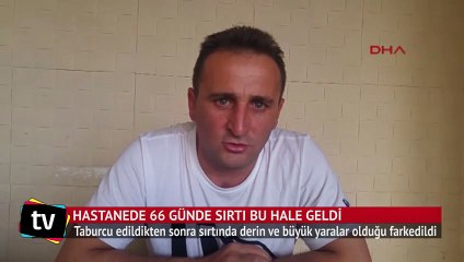 Hastanede 66 günde sırtı bu hale geldi