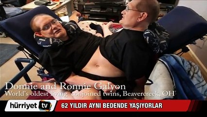 62 Yıldır aynı bedende yaşıyorlar