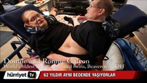 62 Yıldır aynı bedende yaşıyorlar