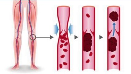 bd-causas-y-tratamientos-contra-la-trombosis-131022