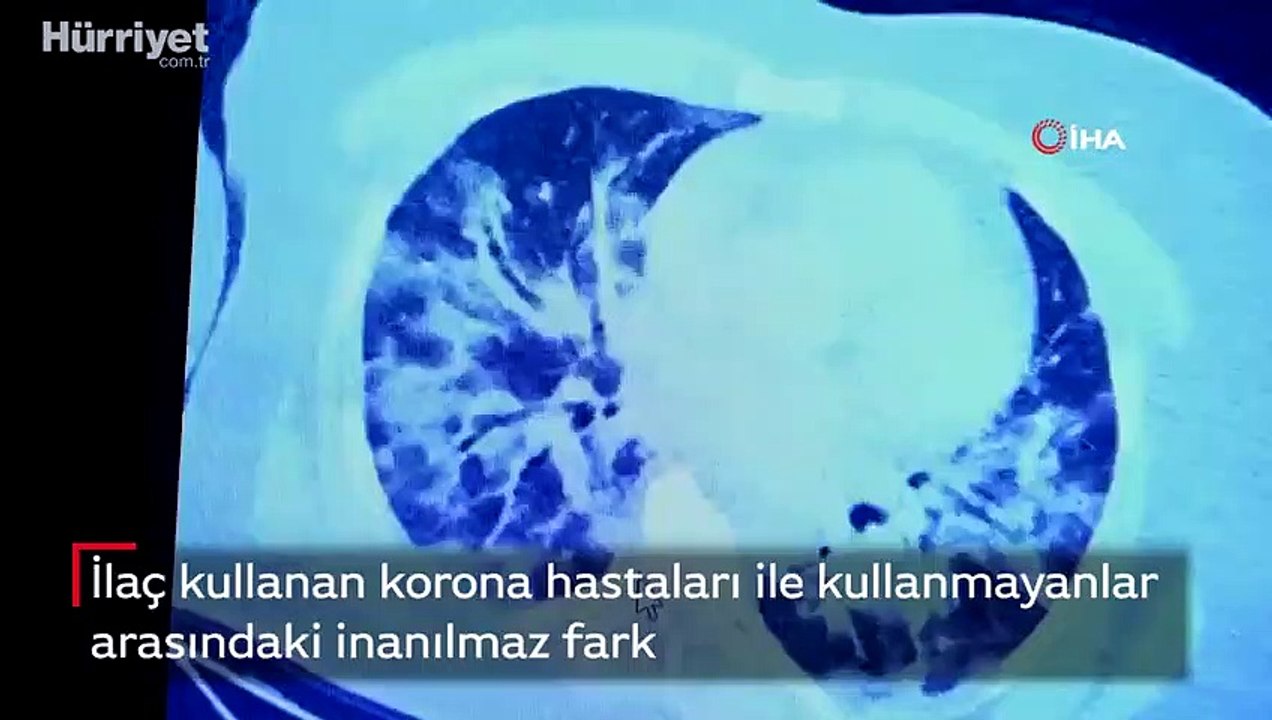 Korona hastalarında ilaç kullanımı sonrası akciğer tutulumu