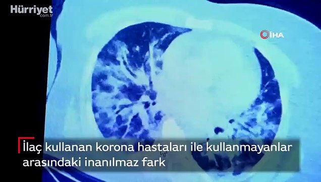 Korona hastalarında ilaç kullanımı sonrası akciğer tutulumu