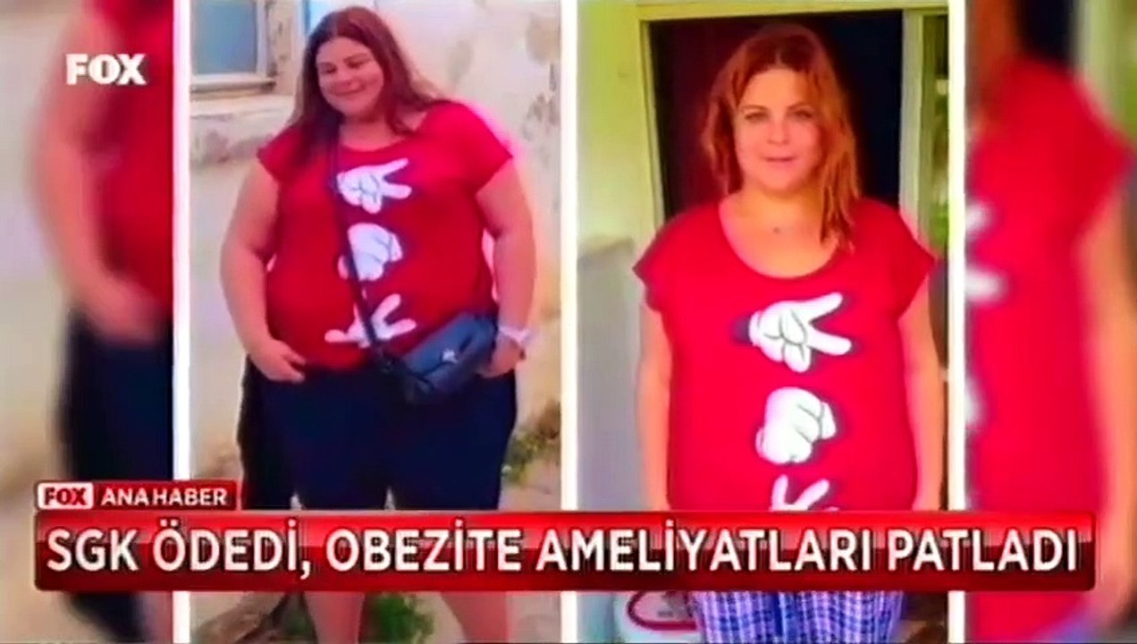 Obezite ameliyatlari patladı